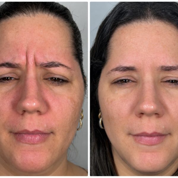 Botox