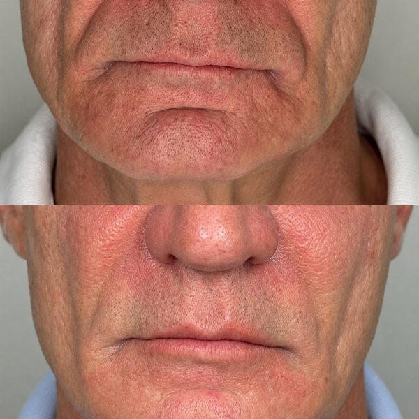 Rejuvenescimento e Harmonização