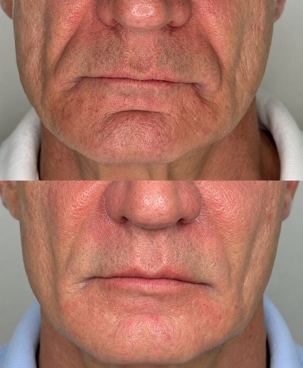 Rejuvenescimento e Harmonização