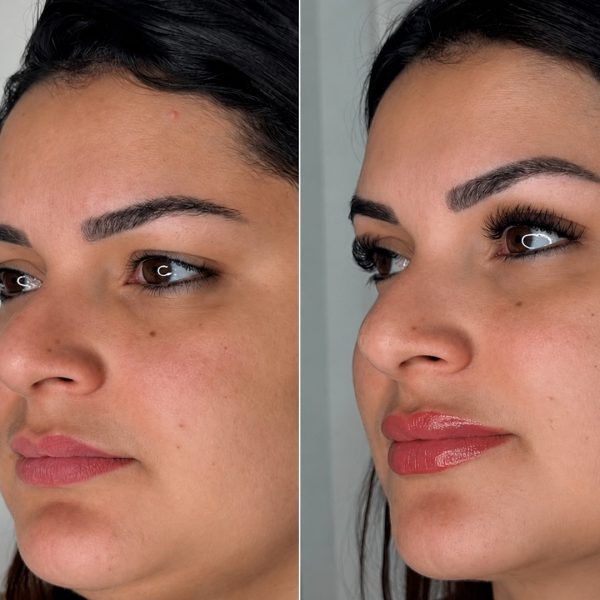 Harmonização Facial