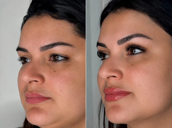 Harmonização Facial
