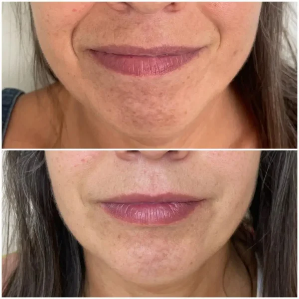 Harmonização Facial