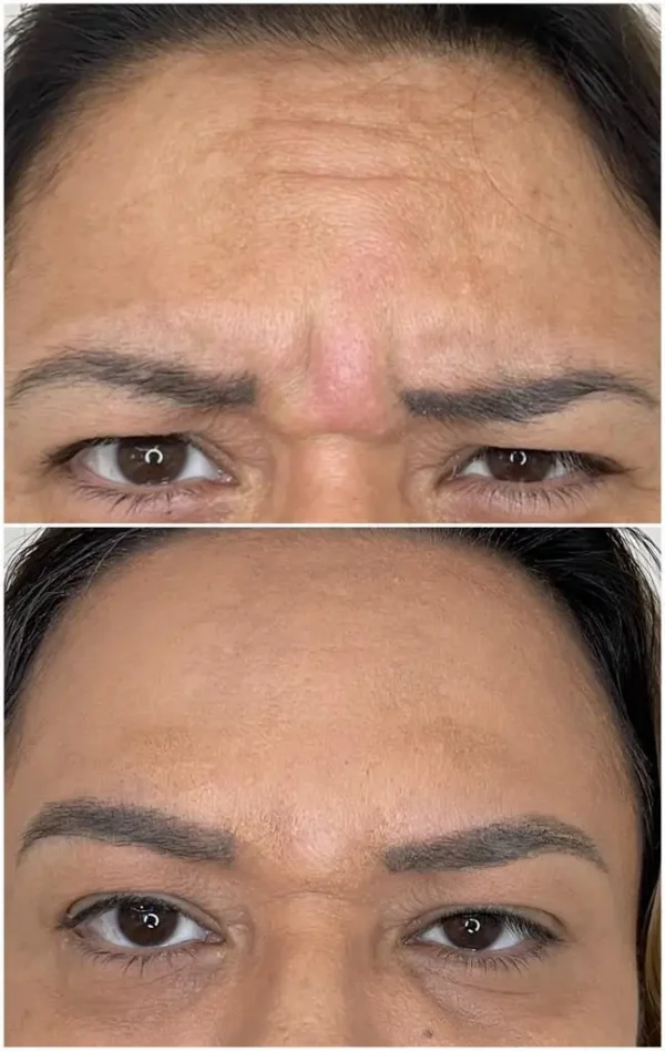 Botox Clinic