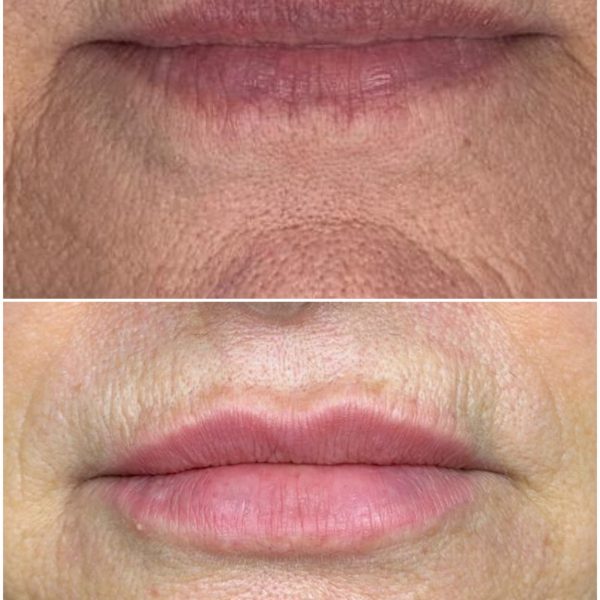 labio
